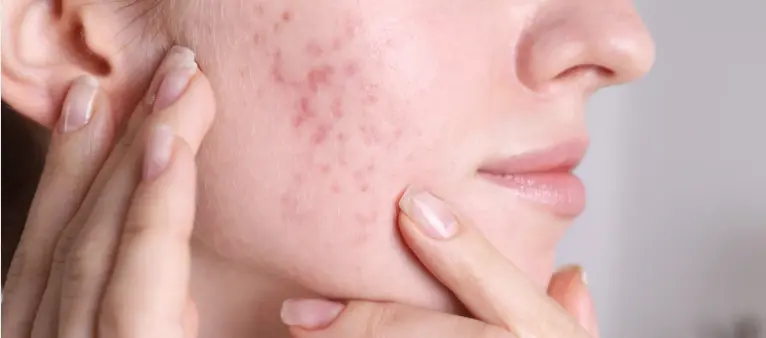 Gentle Acne Treatment and Pore Management