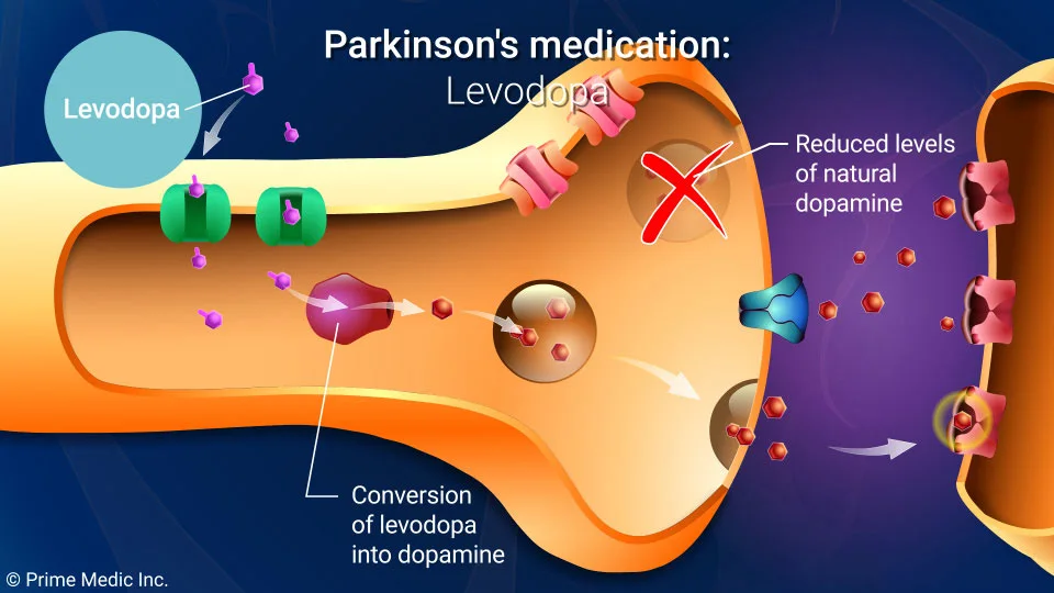  Treatment and Management of Parkinson’s Disease