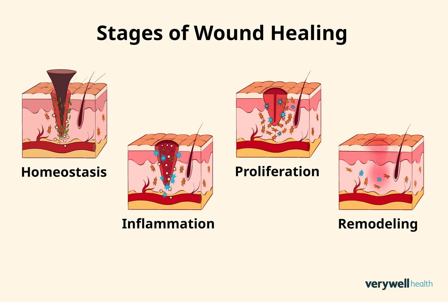 inflammation inflammation