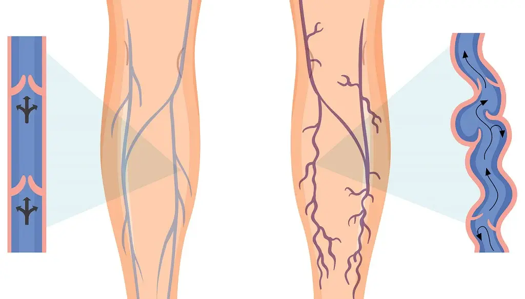 Horse Chestnut Extract Benefits Horse Chestnut Extract Benefits